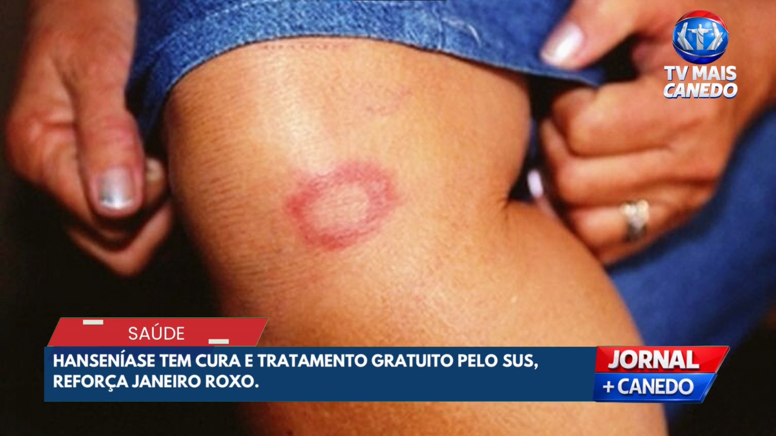Janeiro Roxo reforça conscientização e combate à hanseníase em Senador Canedo