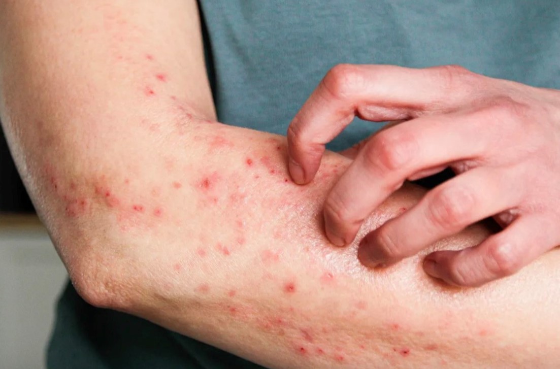 Goiás Investiga Cinco Casos Suspeitos de Mpox em 2026